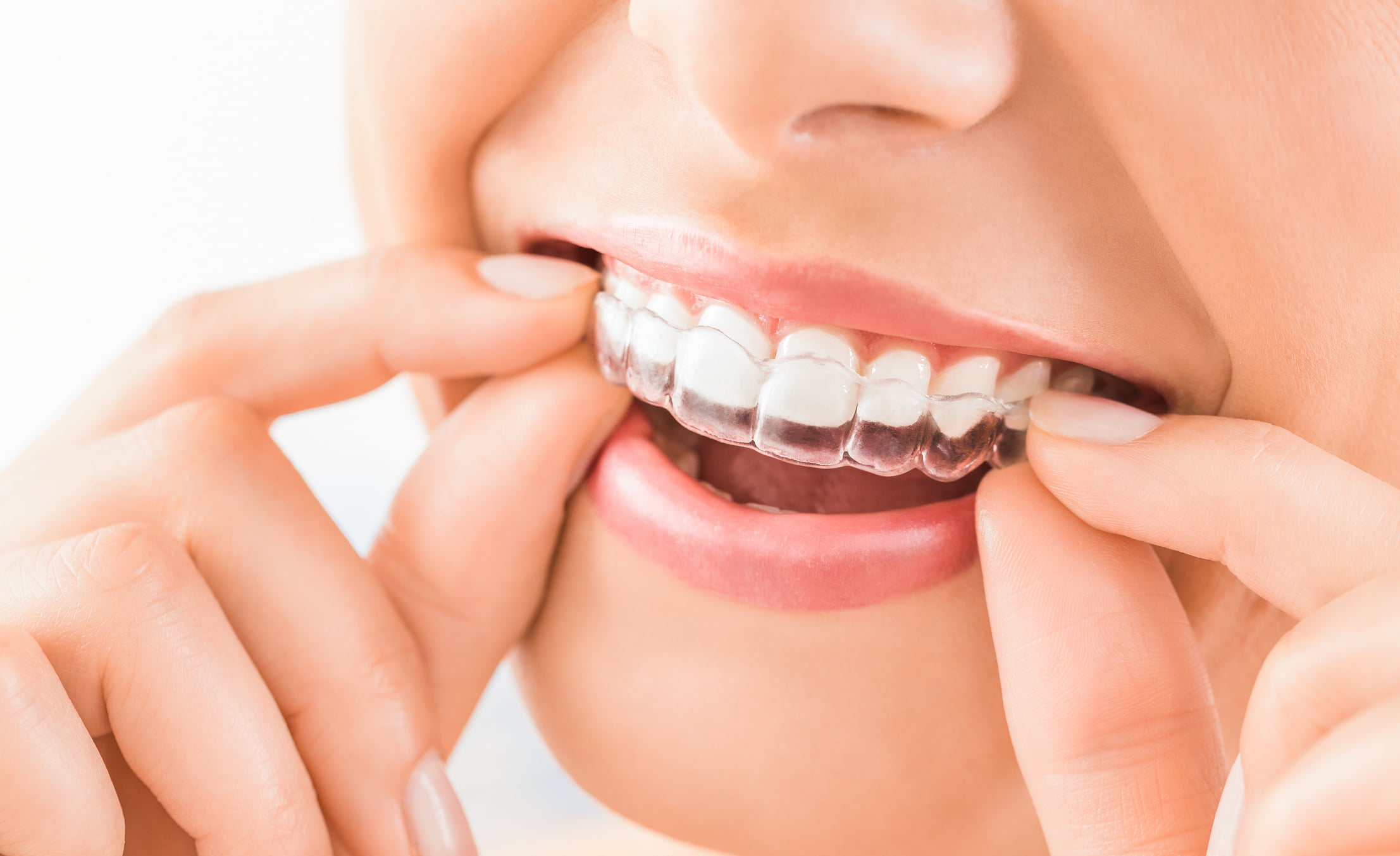 Invisalign 101 How It Works Pros Cons Cost Maple Dental Health Blog