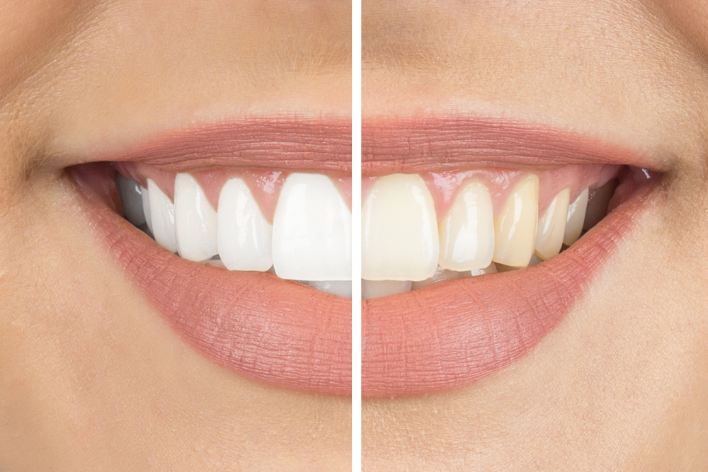 How Much Does Teeth Whitening Cost in Massachusetts? - Emerson