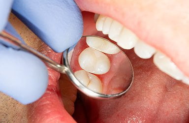 dental-sealant