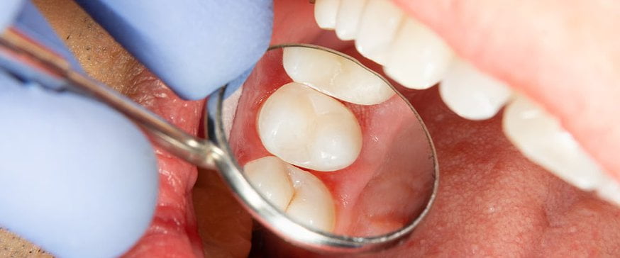 dental-sealant