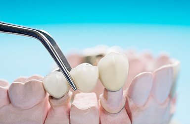 teeth-crown-bridge-implant-dentistry