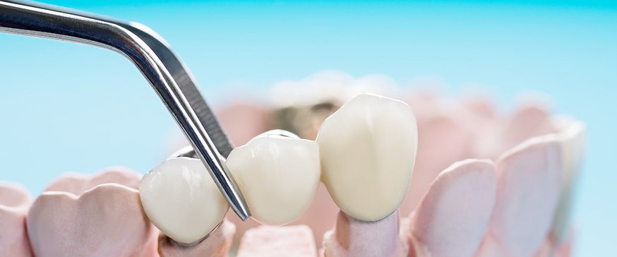 teeth-crown-bridge-implant-dentistry