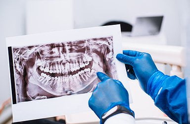 wisdom-teeth-to-be-removed