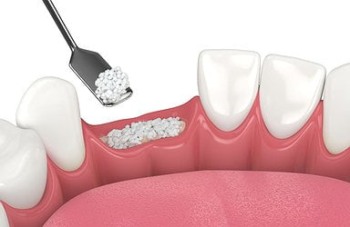 dental-bone-grafting