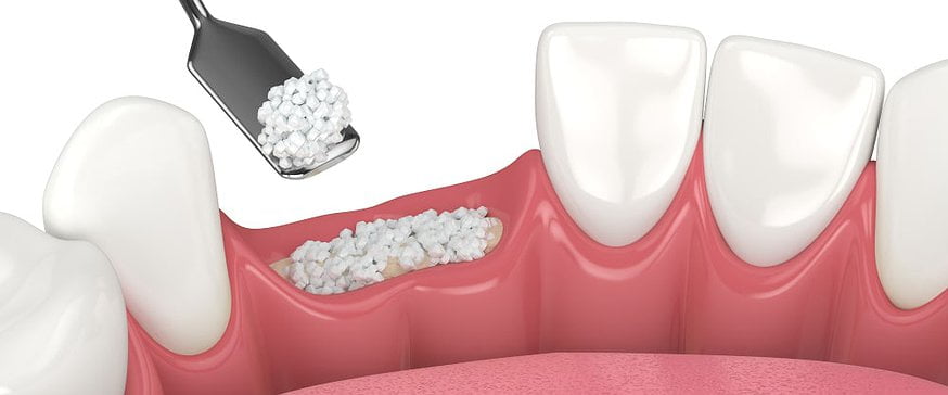 dental-bone-grafting