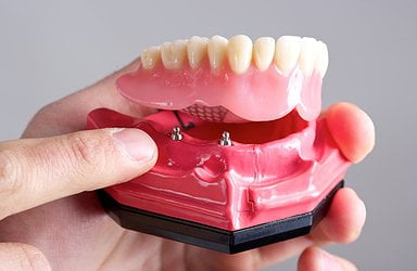 dental-implant-photo