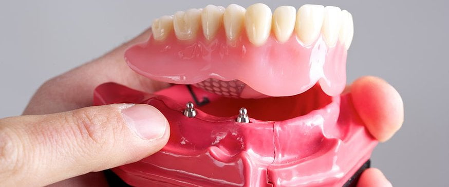 dental-implant-photo