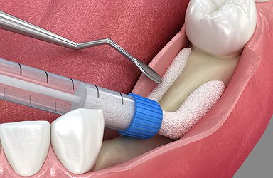 bone-grafting