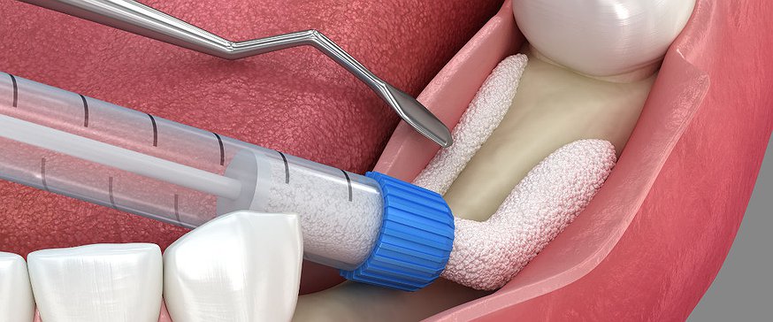 bone-grafting