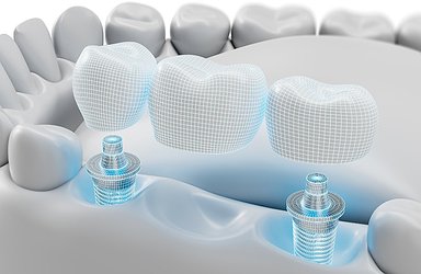dental-implant-bridge-concept