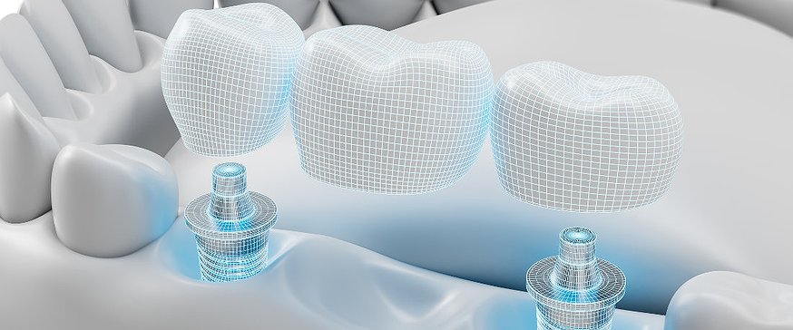 dental-implant-bridge-concept