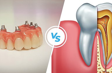 root-canal-versus-implant