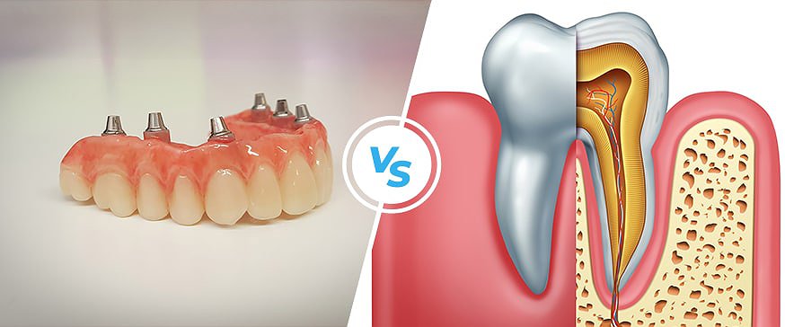 root-canal-versus-implant