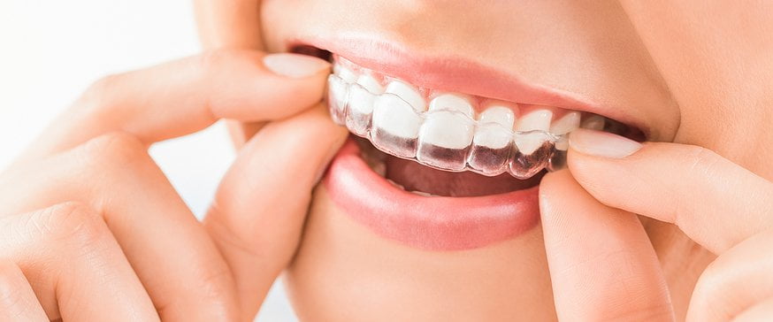 invisalign dentist