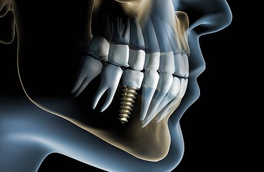 skull-with-dental-implant