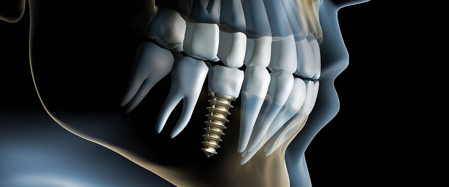 skull-with-dental-implant