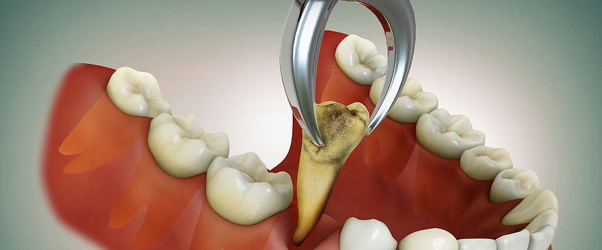 tooth-extracted