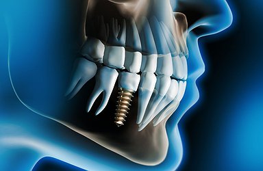 tooth-x-rays
