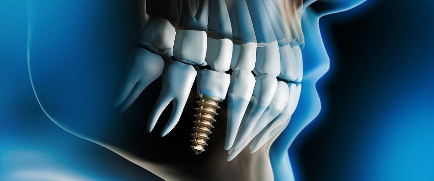 tooth-x-rays
