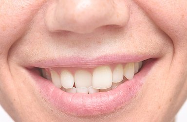 woman-crooked-teeth