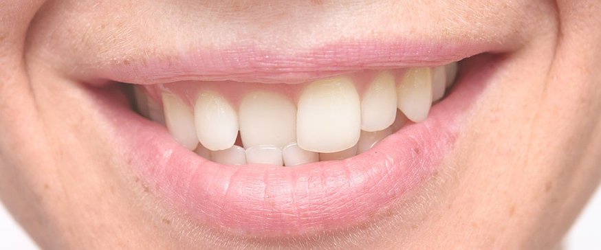 woman-crooked-teeth