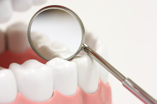 White Fillings