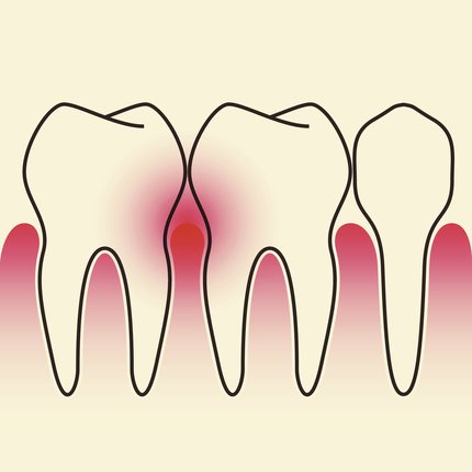Periodontal Gum Treatment