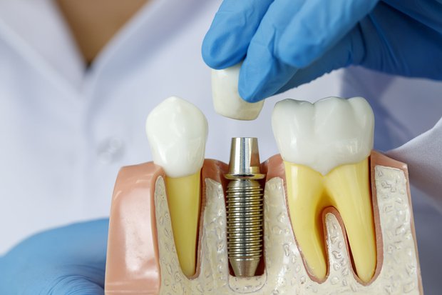 Mini Dental Implants