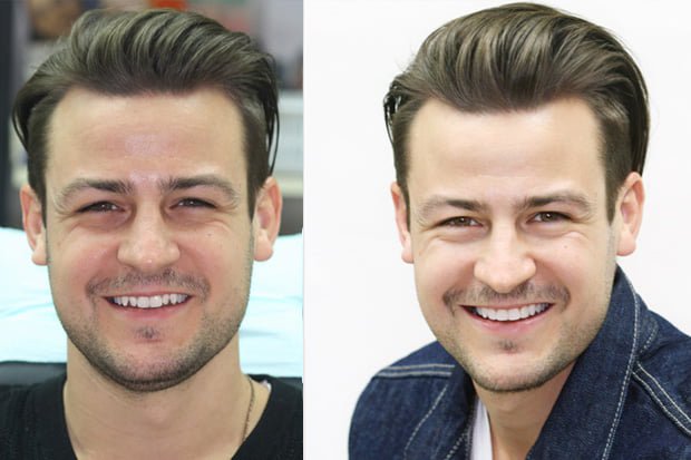 Veneers